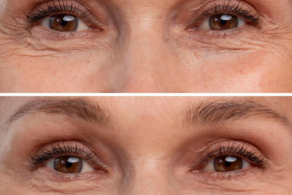 Blefaroplastika vjeđa